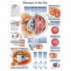 VR1231 DISEASES OF THE EYE POSTER  
